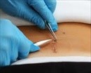 Gloved Hands Suturing Abdomin